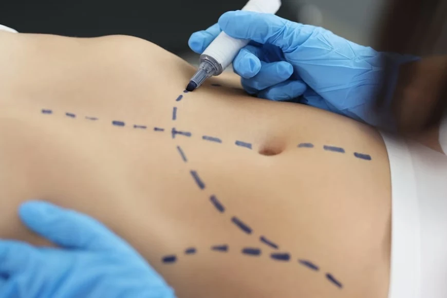 Imagem ilustrativa de Abdominoplastia em Ananindeua